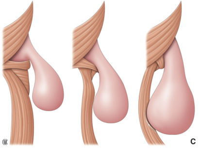 Trattamento endoscopico di diverticolo di Zenker (Z-POEM)